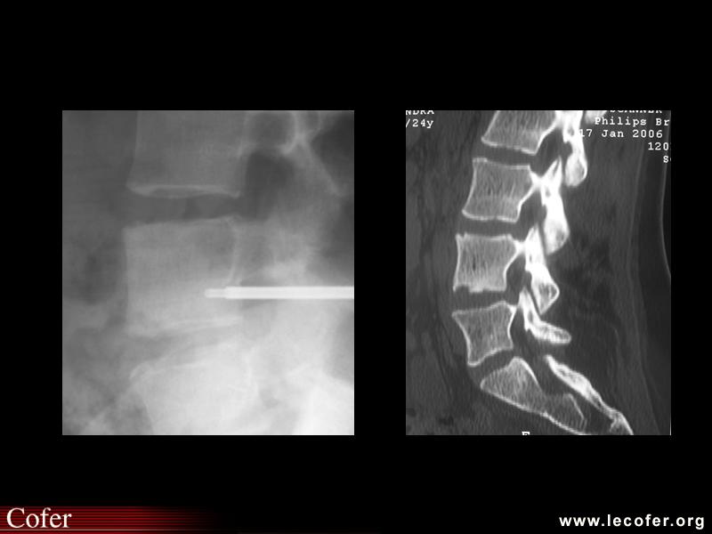 Spondylarthrite ankylosante, spondylite de L4