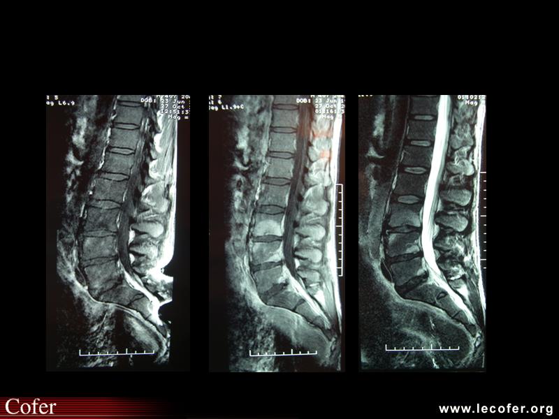 Spondylarthrite ankylosante