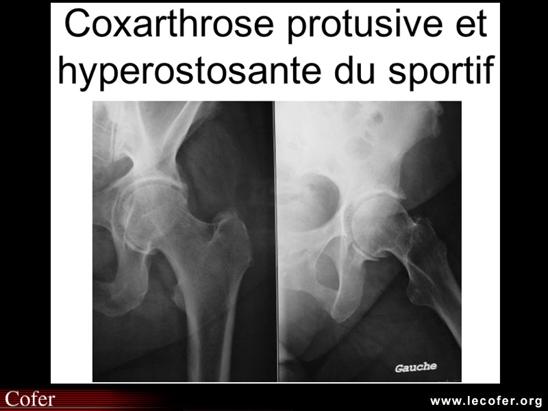 Coxarthrose hyperostosante