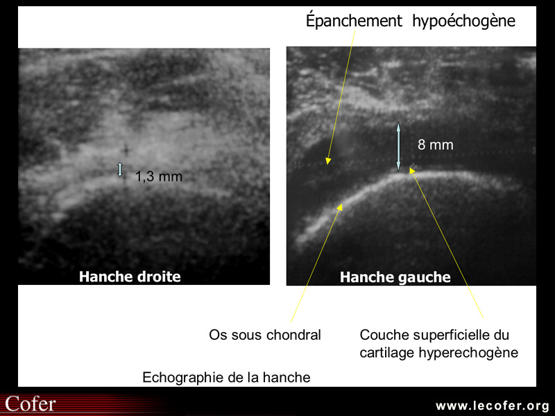 Échographie de la hanche