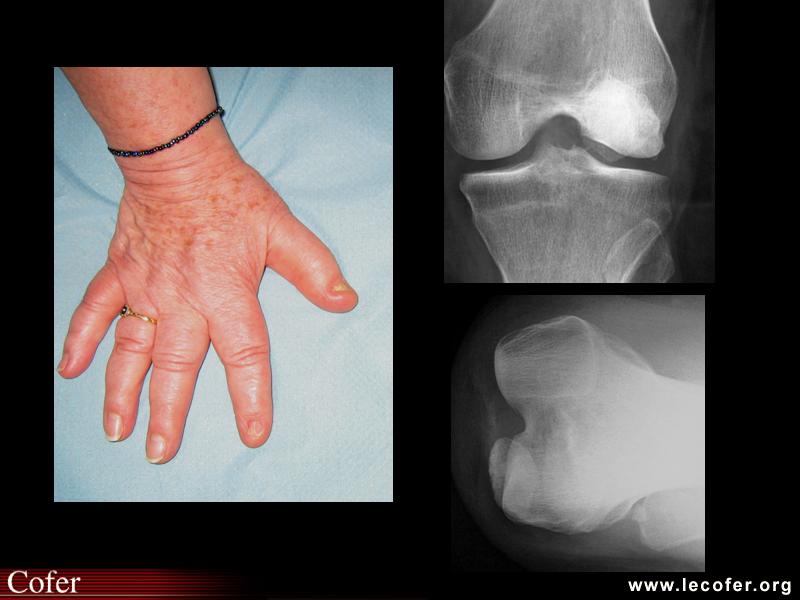 Syndrome nail-patella