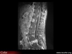 Lymphome vertébral (IRM)