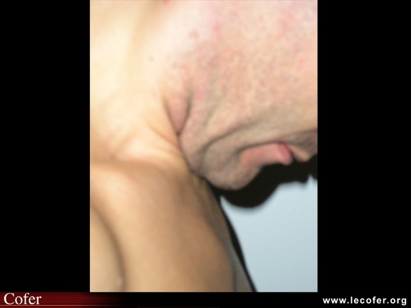 Mesure de la distance menton-sternum en flexion maximale chez un patient normal (vue de profil)