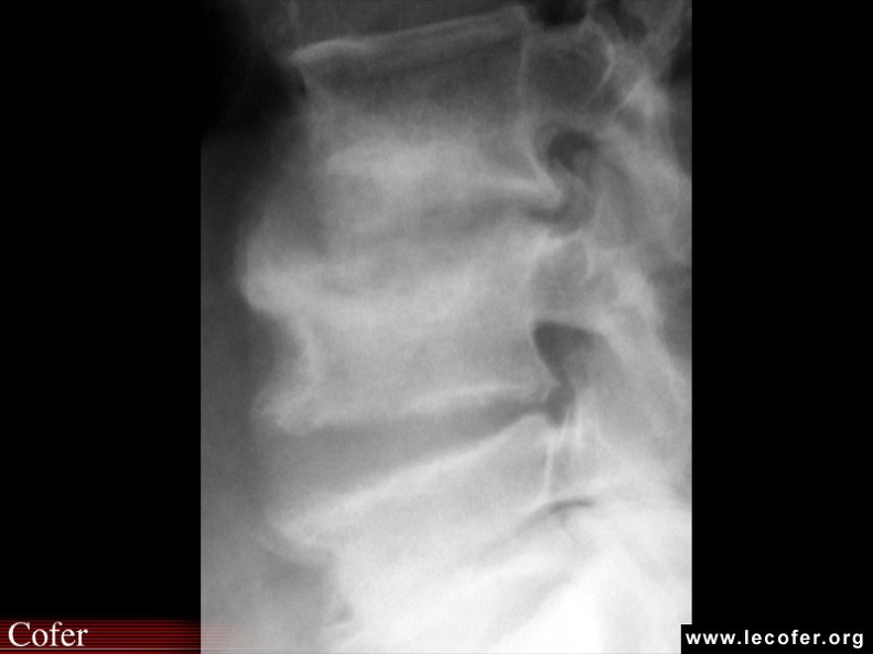 Mal de Pott, tuberculose vertébrale, tuberculose ostéoarticulaire. Radiographie