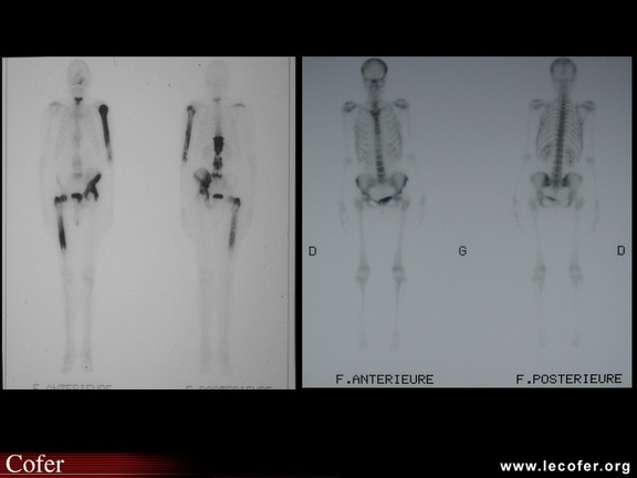 Maladie de Paget : scintigraphie osseuse avec lésions multiples