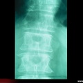 Myélome multiple : Radiographie : perte d’un pédicule
