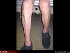 Amyotrophie des muscles de la loge antérieure de la jambe