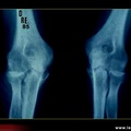 Évolution radiologique au cours de la polyarthrite rhumatoïde : arthrite des deux coudes 12 ans plus tard