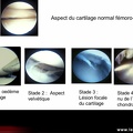Cartilage : Vue macroscopique : érosions du cartilage