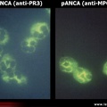 Anticorps anti-cytoplasme des polynucléaires, ANCA