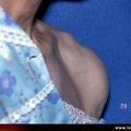 Polyarthrite rhumatoïde, PR débutante, PR ; détection d’une synovite (épanchement) de l’épaule