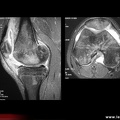Arthrite septique du genou (IRM)