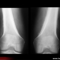 Ostéoarthropathie hypertrophiante pneumique de Pierre Marie