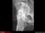 Radiographie de la hanche : faux profil de Lequesne