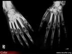 Algodystrophie, algoneurodystrophie de la main droite : caractéristiques radiologiques