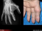 Goutte, goutte tophacée : atteinte caractéristique de la main