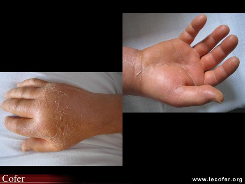 Ce este artrita - cauze, simptome și tratament