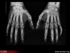 Arthrite septique du poignet
