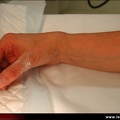 Fracture du poignet, déformation clinique