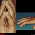Diabète : atteinte de la main, chéiroarthropathie