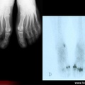 Spondylarthrite ankylosante / SpA / pelvispondylite rhumatismale / spondylarthropathie : atteinte des pieds et avant-pieds