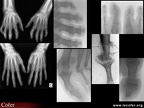 Rhumatisme psoriasique : différents aspects radiologiques de l’atteinte des doigts ou des orteils