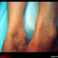 Tendinopathie achilléenne avec épaississement du tendon ; tendinite d'Achille